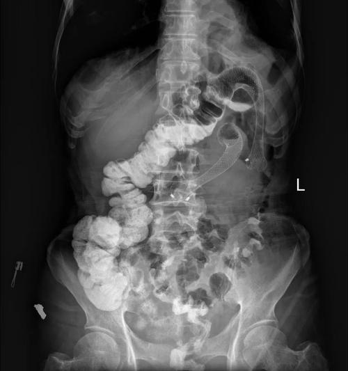 图23 两支架就位良好,肠梗阻缓解,扩张的横结肠回缩,造影剂通过结肠脾