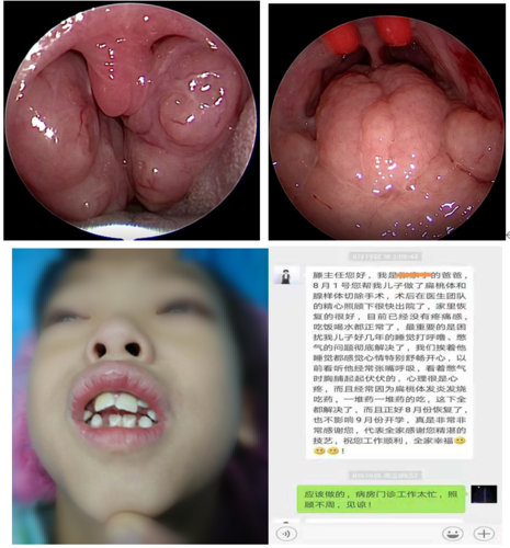 腺样体切还是不切这的确是一个问题