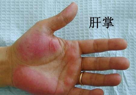 皮肤出现这些"信号",要注意,它们可不是皮肤病!