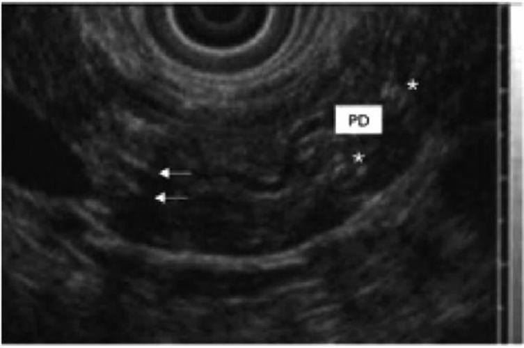 慢性胰腺炎的超声内镜诊断