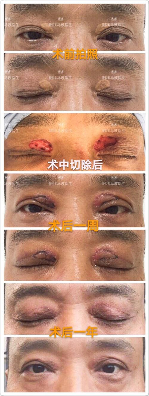 更新第2季眼皮上长了黄斑是怎么回事图片案例篇