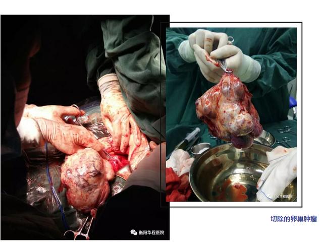 王阿姨患恶性卵巢甲状腺肿合并甲状腺伴甲状腺乳头状癌,手术加行盆腔