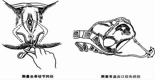 坐骨结节间径的正常值应为