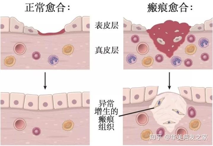 正常情况下,皮肤受到破坏后,表皮层愈合,真皮层纤维适度再生,可能会留