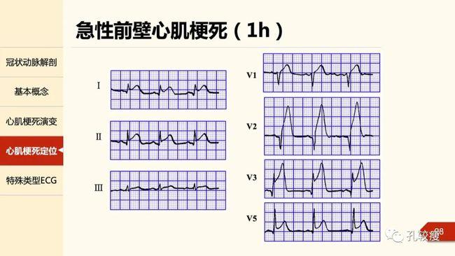 心肌梗死心电图诊断从基础到临床精美课件