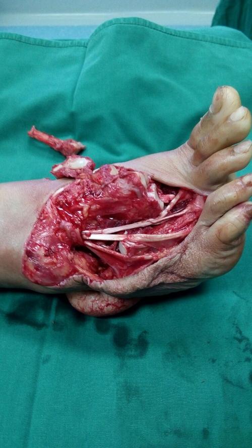 写美篇急诊当天,清创术后.