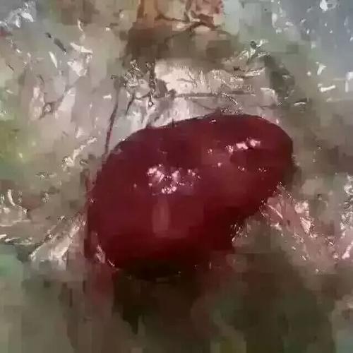 子宫肌瘤患者,排出的垃圾