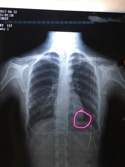 拍了胸片没有报告出来.