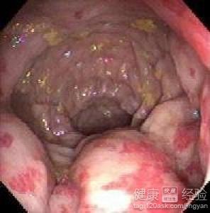 直肠炎的症状也可能会有便秘或者是腹泻等情况交替出现的情况发生