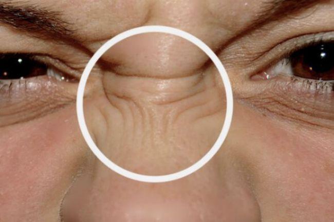 3,眼睛出现老年环