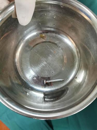 工地气钉枪"走火" 3cm钢钉射入工人右肺险丧命!