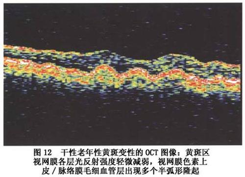光学相干断层扫描术  干性老年性黄斑变性的oct图像主要表现为上,下