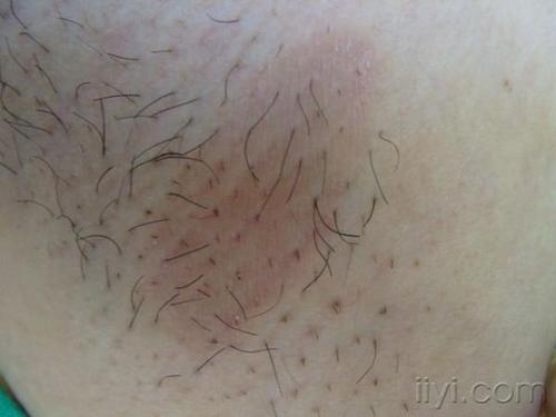 曾患腋毛癣而刮除了腋毛,未用药治疗.