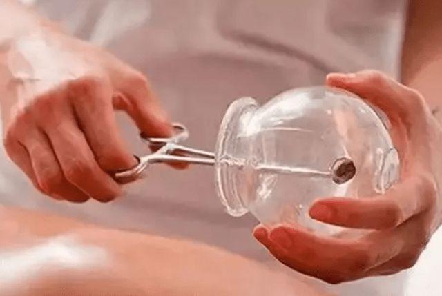 拔火罐时,后背出现的瘀血是排出的毒素吗?多数人想错了