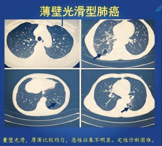 囊腔型肺癌的影像特征与鉴别