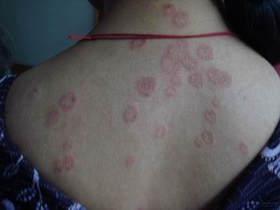 身上长了好几年的癣,不痛不痒的