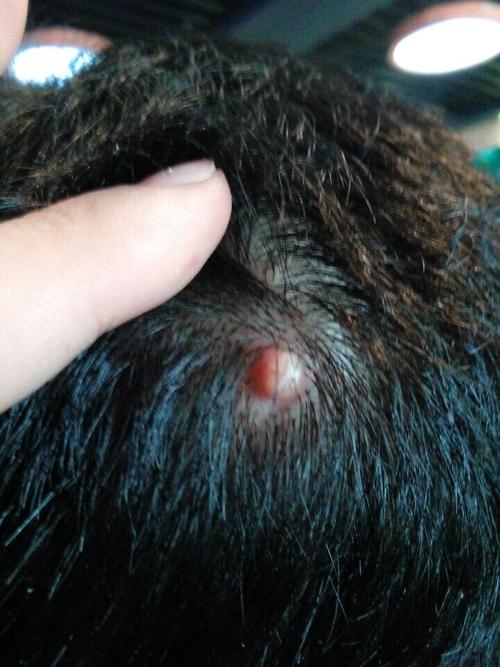 头皮上起了个这包 好害怕 是什么?