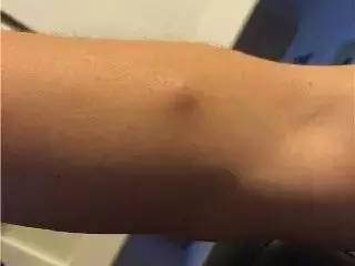 多由皮脂腺囊肿引起,通常不会致癌.