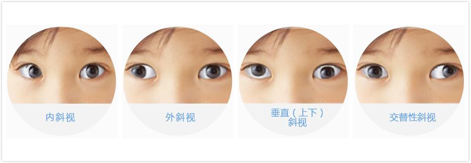 斜视治疗不及时,可能会耽误孩子一辈子!