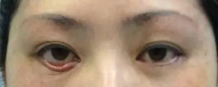 眼袋手术失败后如何修复?杭州市一沈海燕医生谈眼袋修复方案