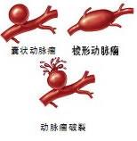 左为颅内动脉瘤示意图;右为常见动脉瘤类型