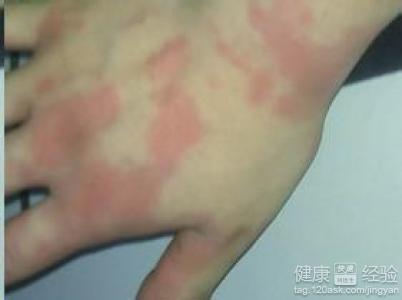 1酒精过敏症状一般表现为喝酒后全身发痒,身体出现起红疙瘩,红斑点等