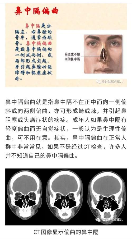 副鼻窦ct诊断为鼻中隔偏曲,它到底有哪些危害?需要治疗吗?