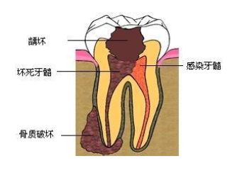 牙髓炎不能自愈必须及时治疗