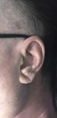 我院大夫看见患者双侧耳垂上存在皱褶,给他做了冠脉cta,发现多发血管