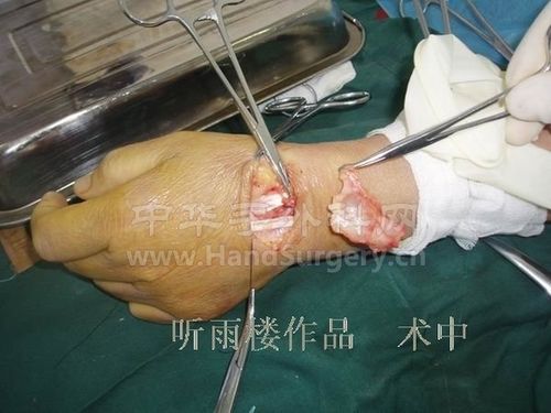 腱鞘囊肿手术全过程