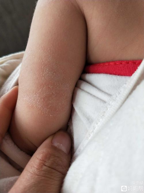 喜欢两个胳膊上面都长了一个不知道是什么,起皮