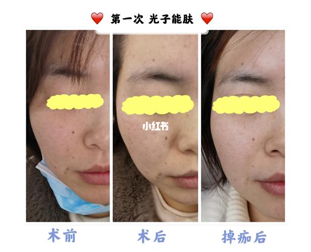 两次光子嫩肤 真实体验_防晒_嫩肤_医用面膜_咖啡_补水面膜_毛孔粗大