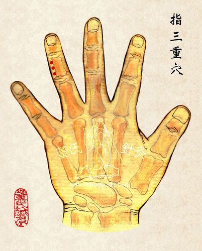 35,董氏奇穴手掌部位之"指三重穴"