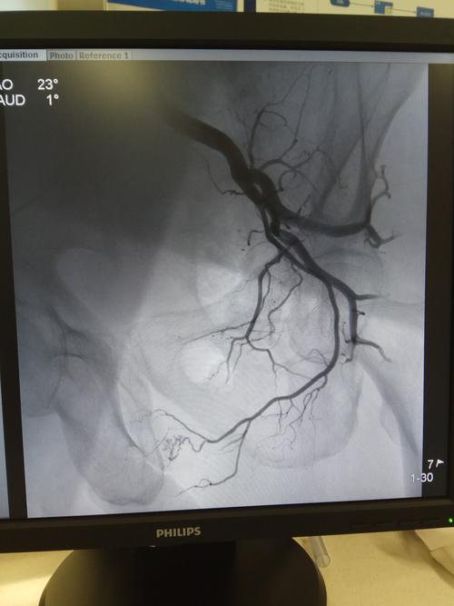 介入微创治疗前列腺增生新方法—超选择插管前列腺动脉造影术 动脉