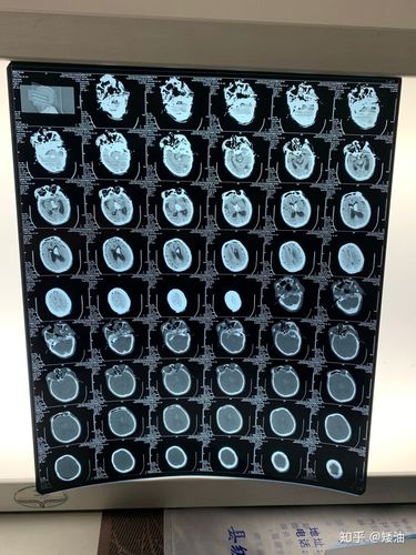 脑ct照片谁能看出症状