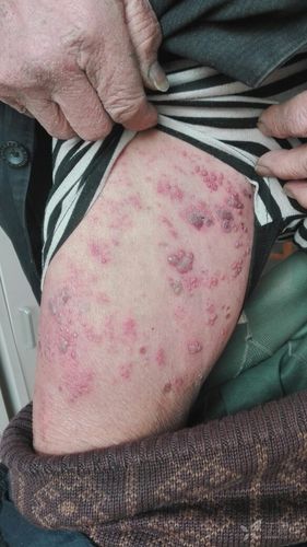 麻烦给看一下,带状疱疹? [病例帖]