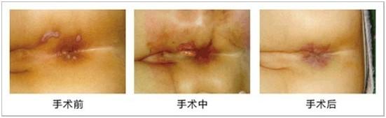 > 肛周脓肿百科       3,若治疗不及时或治疗不恰当易形成肛瘘,给患者
