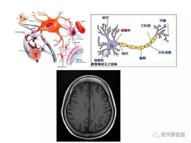 【ppt】脑脱髓鞘疾病的影像诊断