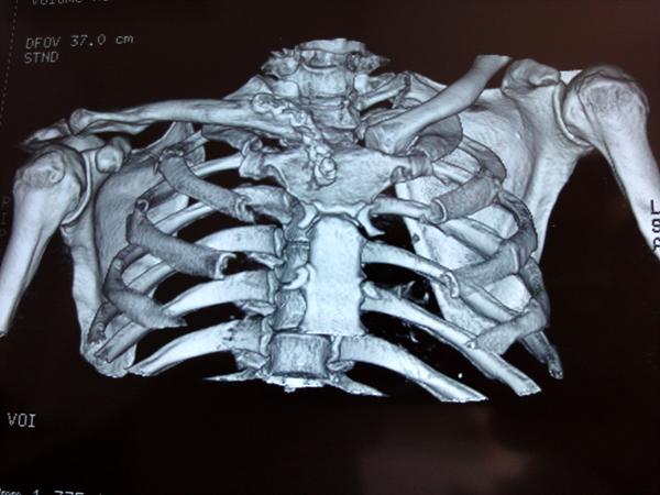 胸锁关节脱位orif