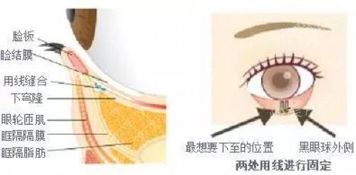 根据设计的线条,在下眼睑最想要下至的部分,和黑眼球外侧的两处用线