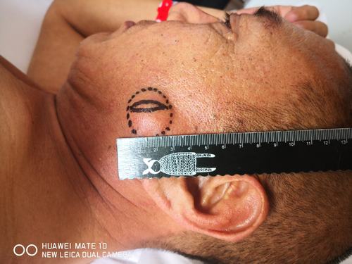 面部肿物(皮脂腺囊肿)切除