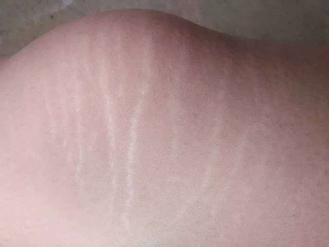 体重增加过快的人就可以见到这种情况,所以也叫肥胖纹,许多在发育期的