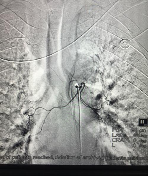 支气管动脉造影左下肺出血