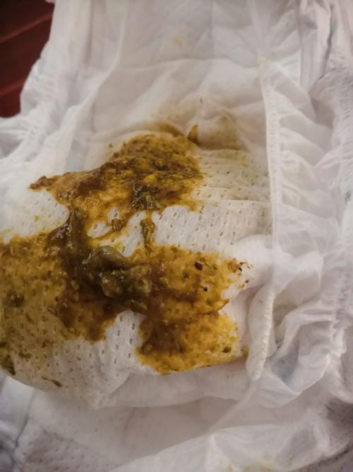 宝宝腹泻,如果没有及时地