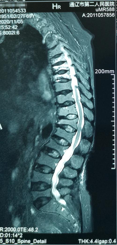 69岁胸椎多发压缩性骨折椎体成型手术一例