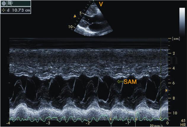 此病令90%的患者出现呼吸困难 如何利用超声心动图鉴别诊断?