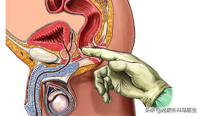什么是慢性盆骨疼痛综合征,前列腺按摩又是什么神仙操作?