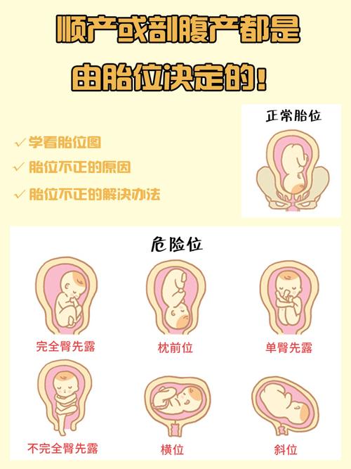 别纠结顺产还是剖腹产了 先学会看胎位图吧_顺产_剖腹