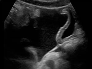 脾破裂——zengerya