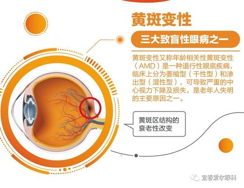 黄斑变性又称年龄相关性黄斑变性,是一种退行性眼底疾病,可导致严重的